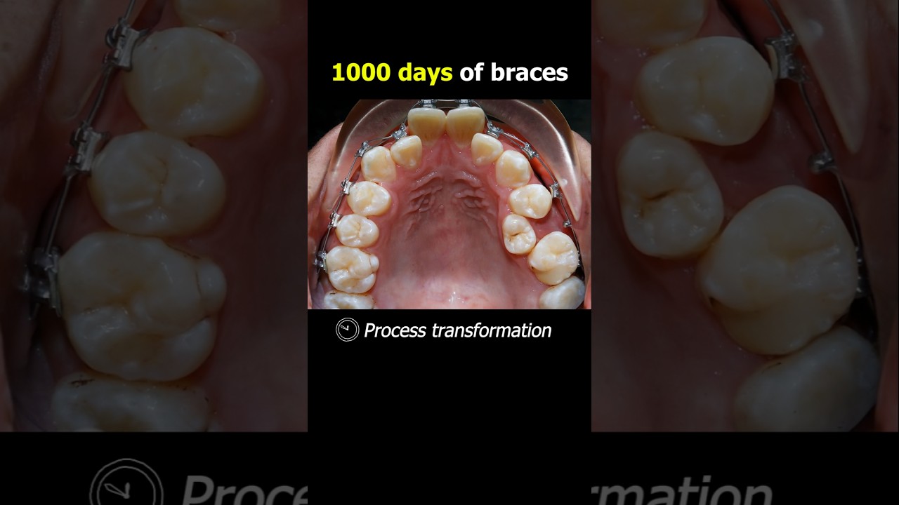 1000 days of braces. Fix crooked and   buck teeth 