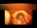 Salute &amp; Chop : Phaco / Cataract surgery in Hyper mature cataract