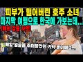 피부가 헐어버린 호주 소녀마지막 여행으로 한국에 가보는데...(매일 얼굴을 쥐어뜯었던 기억 뿐이에요...)