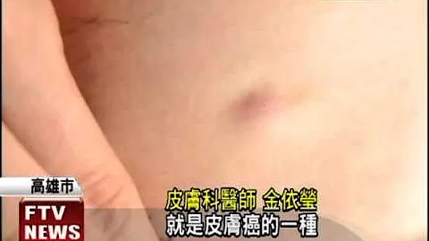 丘疹不痛不癢 小心是惡性腫瘤－民視新聞 - 天天要聞