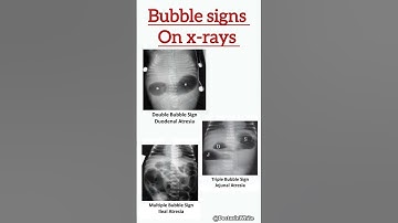 Bubble signs on x-rays  | #viralshorts #bubblesigb #xray