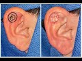 Ear skin cancer - my approach to excision and reconstruction