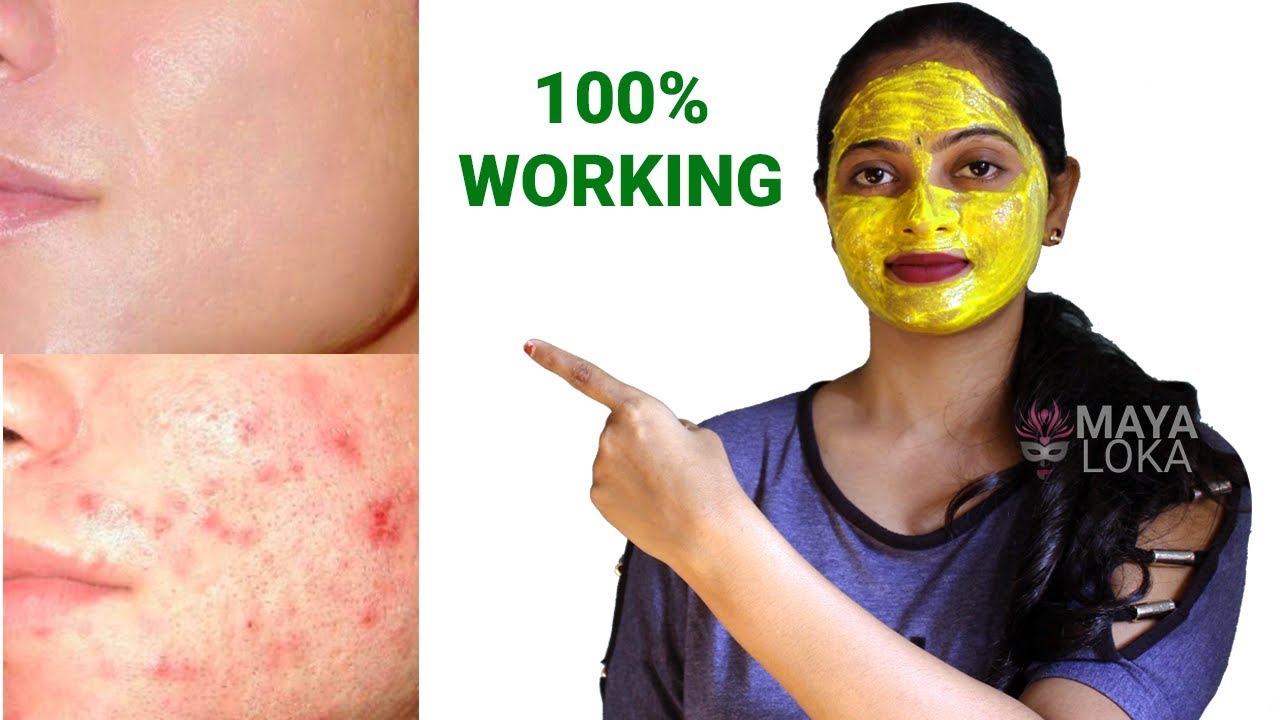 ಮೊಡವೆಗಳಾ? ಆಯಿಲ್ ಸ್ಕಿನ್? ಇವೆರಡನ್ನೂ ಬೆರಸಿ ಒಮ್ಮೆ ಹಚ್ಚಿ ನೋಡಿ | Get rid of Pimples and oily skin problems