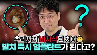 원데이임플란트 필수 조건 알아보기│잇몸의 &#39;이것&#39; 확인하는 이유