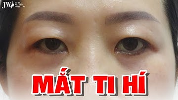 Cắt mắt hai mí đẹp long lanh, người phụ nữ thoát kiếp muộn sầu