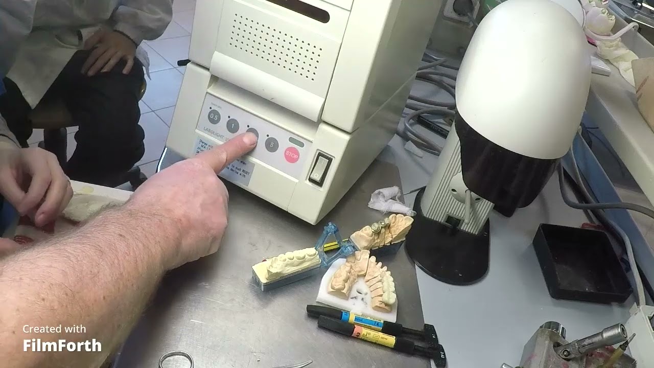 resinatura in fotopolimerizzabile di una travata di 3 elementi dentali