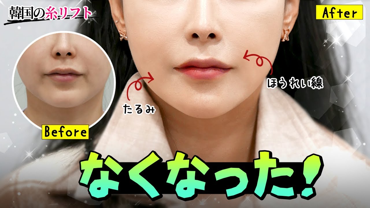 韓国整形】 糸リフトについて本気で説明します！糸リフトで確実に効果