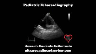 Asymmetrical Hypertrophic Cardiomyopathy