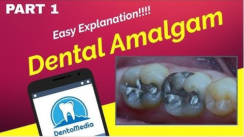 Dental Amalgam Part 1: Definitions, History, Classification and Basic Constituents