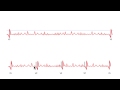 Pacemaker issues explained part 3 navigating oversensing