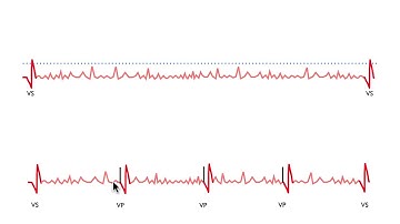 Pacemaker Issues Explained (Part 3): Navigating Oversensing