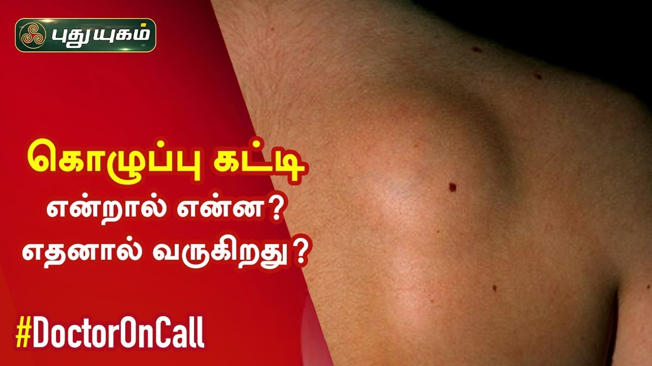 கொழுப்பு கட்டி என்றால் என்ன? எதனால் வருகிறது? Doctor On Call | 31122019 -  YouTube