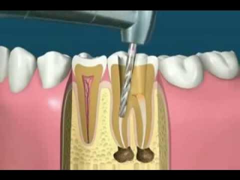 Les mini-vis en orthodontie, Dr Eric Ursat