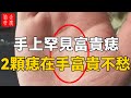 手上罕見富貴痣，2顆痣在手、富貴不愁，快來看看你有沒有