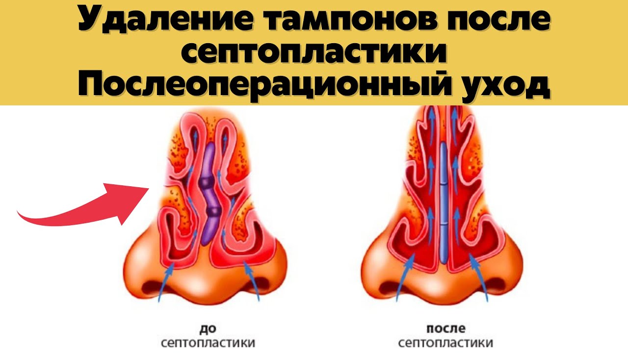 Тампоны в нос после операции