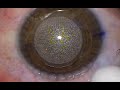 Actual smile eye laser vision correction procedure