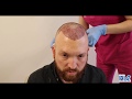 Hair Transplant Turkey - What you need to know