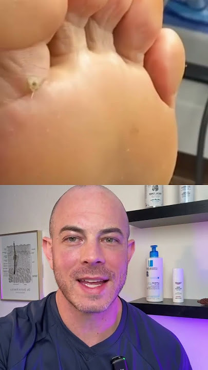 Derm reacts to pus filled infection on foot! #dermreacts #doctorreacts #pimplepop