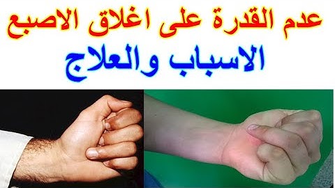 عدم القدرة على اغلاق الاصبع