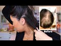 How I Grew My Hair Back Naturally! My Hair Loss Journey (Before and After)