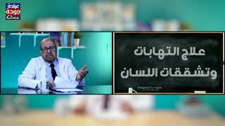 تشققات اللسان 720p | دكتور جودة محمد عواد