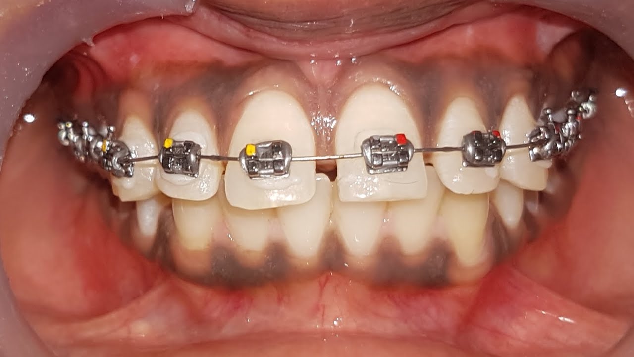 Orthodontic Bracket placement dentist braces orthodontics teeth 
