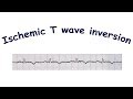 Mechanism of ischemic T wave inversion