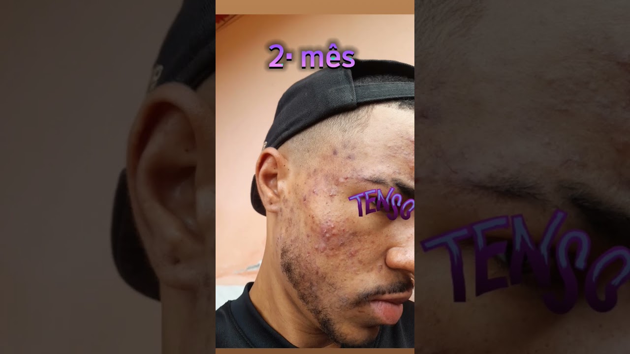 3 MESES USANDO ROACUTAN   #roacutan #isotretinoina #dermatologia #pele #saude #espinha