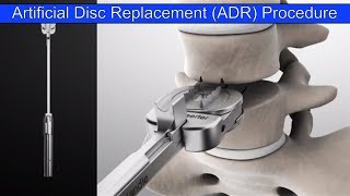 Artificial Disc Replacement Process with M6 Disc from Spinal Kinetics.  Courtesy of ENANDE GMBH