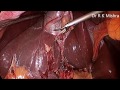 Gallbladder Stone Surgery