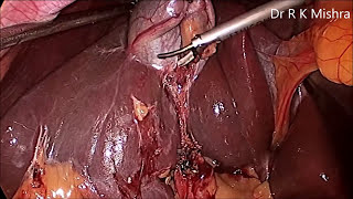 Gallbladder Stone Surgery