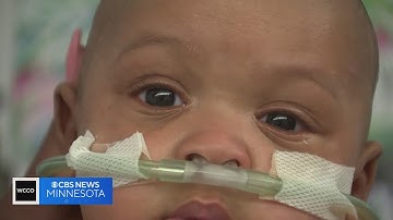 Pennsylvania baby receives smallest pacemaker in the world