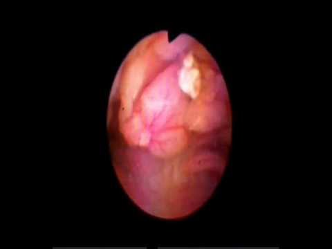 Video: Endometrija Hiperplāzija - Dziedzeru Endometrija Hiperplāzijas Veidi, Cēloņi Un Simptomi