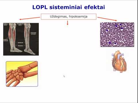 Video: Intersticinės Plaučių Ligos Ir Bronchektazių Skirtumas