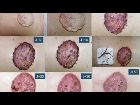 Vidéo: Rentabilité Et Valeur De L'analyse Des Informations D'un Environnement à Faible Friction Après Une Greffe De Peau Chez Des Patients Souffrant De Brûlures