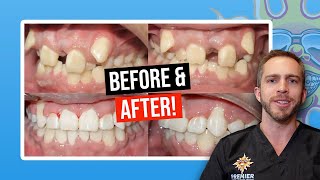 Braces BEFORE & AFTER: Severe Crowding!