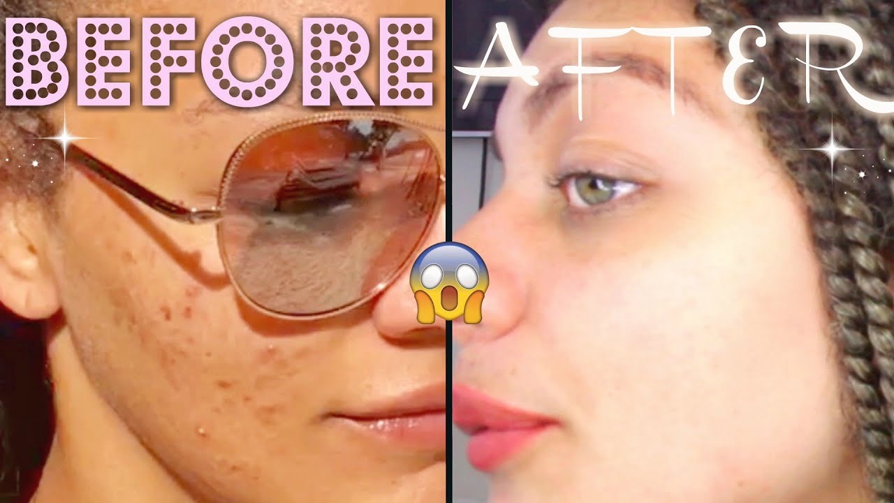 CLEAR SKIN FAST AF // How I Cleared My Acne In Two Months girl boss mataro