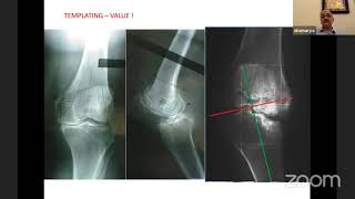 Principles of Total Knee Arthroplasty - Dr SKS Smarya