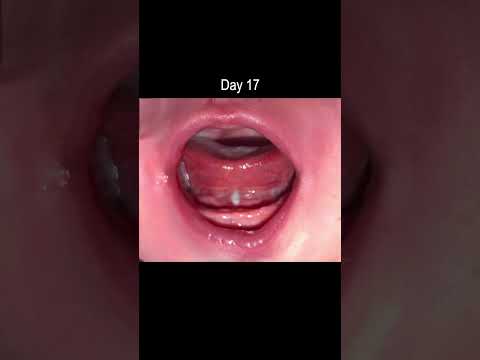 Tongue Tie Release - Healing Time Lapse