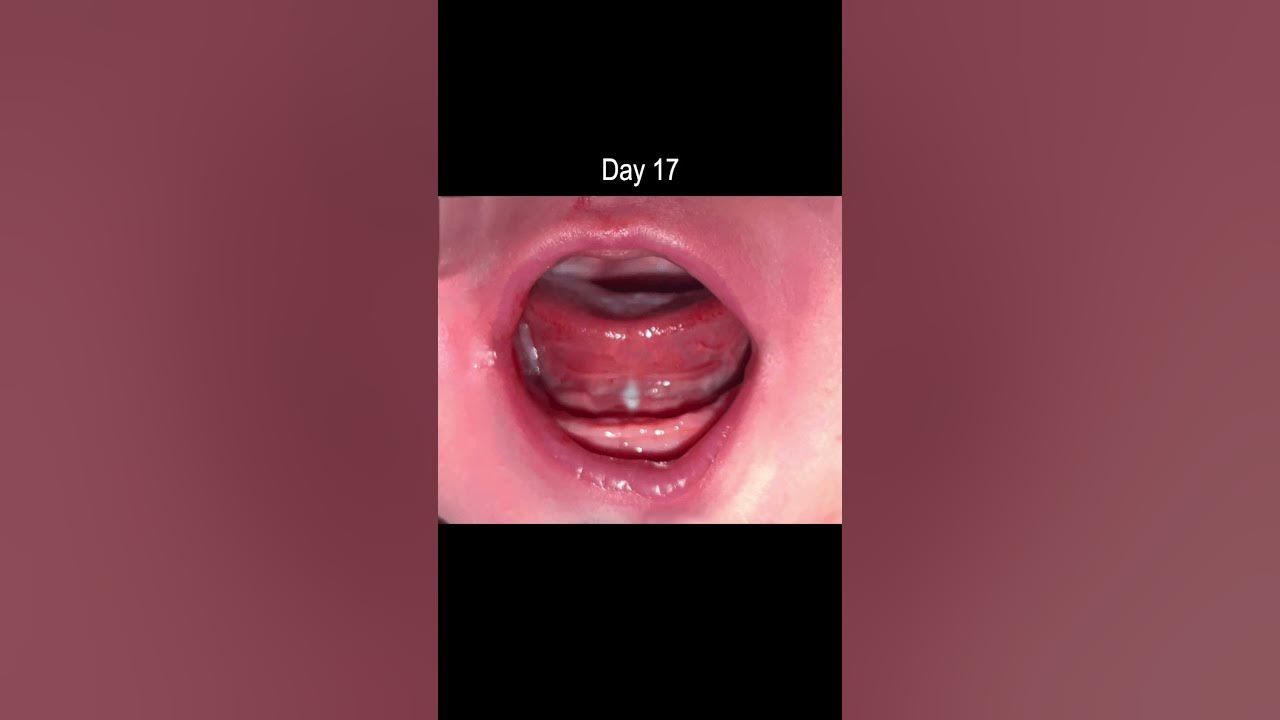 tongue-tie-release-healing-time-lapse-youtube