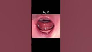 Tongue Tie Release - Healing Time Lapse