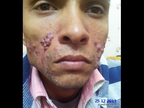 Acne Vulgaris Homoeopathic Cure Dr Ravi Singh