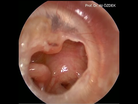 endoskopik kulak zarı ameliyatı