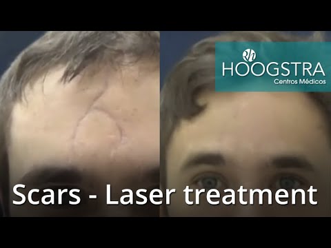 Scars – Laser treatment (20202)