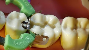 Composite Fill Walkthrough (tutorial) for #19 MO Approximal Box and Occlusal Fill