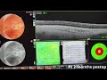 Placing an encircling element at the end of the vitrectomy