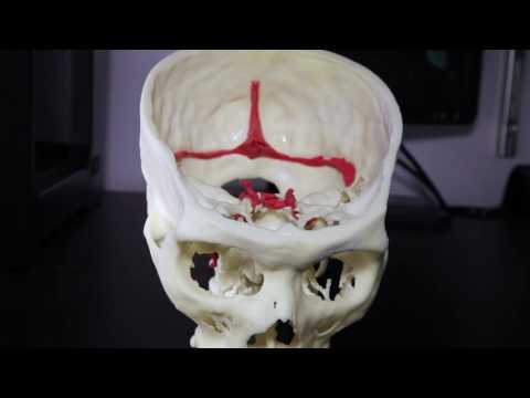 3D Printing at Mount Sinai