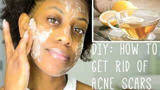 Hey guys! thought i'd share my diy face mask to get rid of acne scars
for this weeks video. link last video: https://www./watch?v=in4zi...
----...