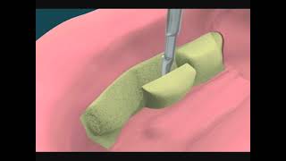 Dental Video For Tori Removal For Mandibular Denture - The Tooth
