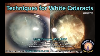 CataractCoach 1351: techniques for white cataracts